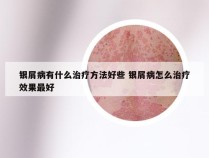 银屑病有什么治疗方法好些 银屑病怎么治疗效果最好