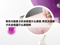 男性大腿里子长皮癣是什么原因 男性大腿里子长皮癣是什么原因呢