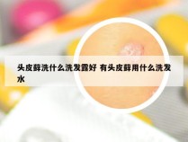 头皮藓洗什么洗发露好 有头皮藓用什么洗发水