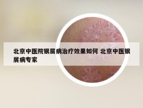 北京中医院银屑病治疗效果如何 北京中医银屑病专家