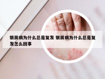 银屑病为什么总是复发 银屑病为什么总是复发怎么回事