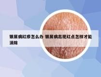 银屑病红疹怎么办 银屑病出现红点怎样才能消除