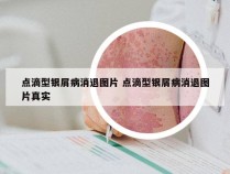 点滴型银屑病消退图片 点滴型银屑病消退图片真实