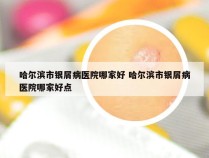 哈尔滨市银屑病医院哪家好 哈尔滨市银屑病医院哪家好点