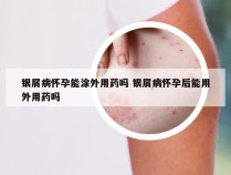 银屑病怀孕能涂外用药吗 银屑病怀孕后能用外用药吗