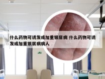 什么药物可诱发或加重银屑病 什么药物可诱发或加重银屑病病人