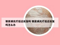 银屑病光疗后还反复吗 银屑病光疗后还反复吗怎么办