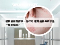 银屑病和荨麻疹一样样吗 银屑病和寻麻疹是一样的病吗?