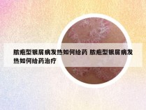 脓疱型银屑病发热如何给药 脓疱型银屑病发热如何给药治疗