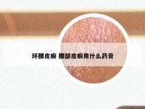 环腰皮癣 腰部皮癣用什么药膏