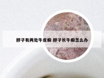 脖子有两处牛皮癣 脖子长牛癣怎么办