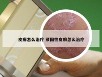 皮癣怎么治疗 顽固性皮癣怎么治疗