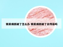 银屑病抓破了怎么办 银屑病抓破了会传染吗