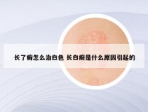 长了癣怎么治白色 长白癣是什么原因引起的