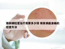 银削病检查治疗需要多少钱 银屑病最准确的检查方法