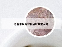 患有牛皮癣会传染给其他人吗