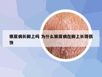 银屑病长脚上吗 为什么银屑病在脚上长得很快