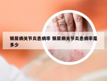 银屑病关节炎患病率 银屑病关节炎患病率是多少