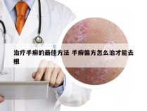 治疗手癣的最佳方法 手癣偏方怎么治才能去根