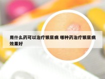 用什么药可以治疗银屑病 哪种药治疗银屑病效果好