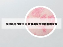 皮肤出现白斑图片 皮肤出现白斑都有哪些病