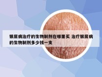 银屑病治疗的生物制剂在哪里买 治疗银屑病的生物制剂多少钱一支