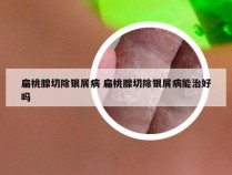 扁桃腺切除银屑病 扁桃腺切除银屑病能治好吗