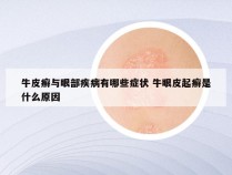 牛皮癣与眼部疾病有哪些症状 牛眼皮起癣是什么原因