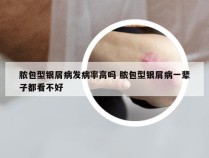 脓包型银屑病发病率高吗 脓包型银屑病一辈子都看不好