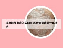 浑身都发皮癣怎么回事 浑身都是癣是什么情况