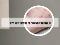 牛气藓会遗传吗 牛气癣可以用的乳膏