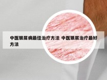 中医银屑病最佳治疗方法 中医银屑治疗最好方法