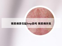 银屑病贵引起bnp高吗 银屑病改变