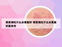 银屑病吃什么水果最好 银屑病吃什么水果最好最有效