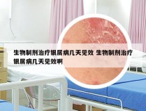 生物制剂治疗银屑病几天见效 生物制剂治疗银屑病几天见效啊