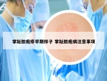 掌趾脓疱疹早期样子 掌趾脓疱病注意事项