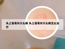 头上容易长什么癣 头上容易长什么癣怎么治疗