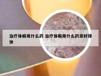 治疗体癣用什么药 治疗体癣用什么药膏好得快