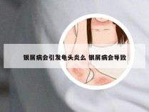 银屑病会引发龟头炎么 银屑病会导致