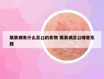 银屑病有什么忌口的食物 银屑病忌口哪些东西