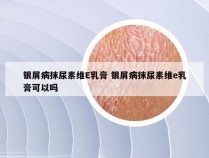 银屑病抹尿素维E乳膏 银屑病抹尿素维e乳膏可以吗