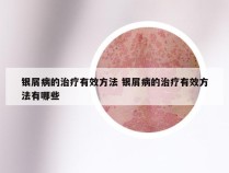 银屑病的治疗有效方法 银屑病的治疗有效方法有哪些