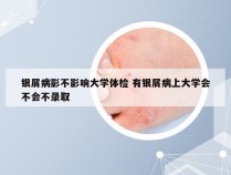 银屑病影不影响大学体检 有银屑病上大学会不会不录取