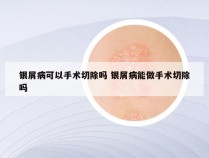 银屑病可以手术切除吗 银屑病能做手术切除吗