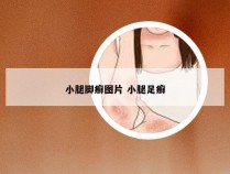 小腿脚癣图片 小腿足癣