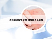 怎样能消除银屑病 银屑病怎么去屑