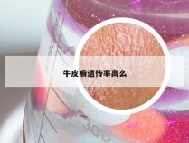 牛皮癣遗传率高么