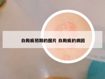 白殿疯初期的图片 白殿疯的病因