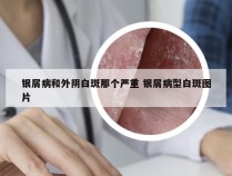 银屑病和外阴白斑那个严重 银屑病型白斑图片