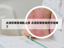 点滴型银屑病脸上痒 点滴型银屑病突然变痒了